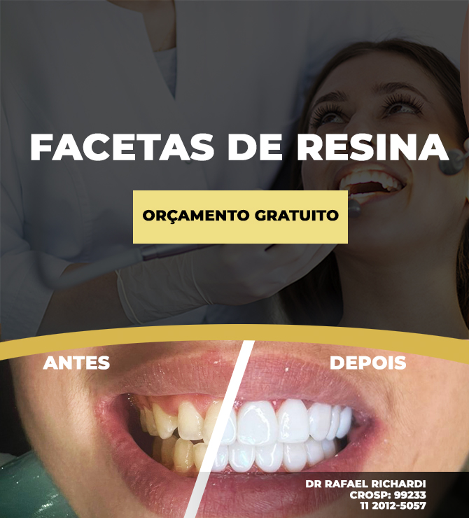 Facetas em Resina - Clínica Odontológica Dr. Mateo Bei