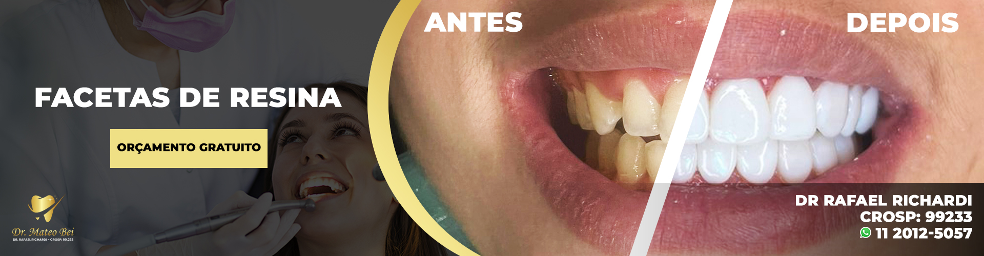 Facetas em Resina - Clínica Odontológica Dr. Mateo Bei