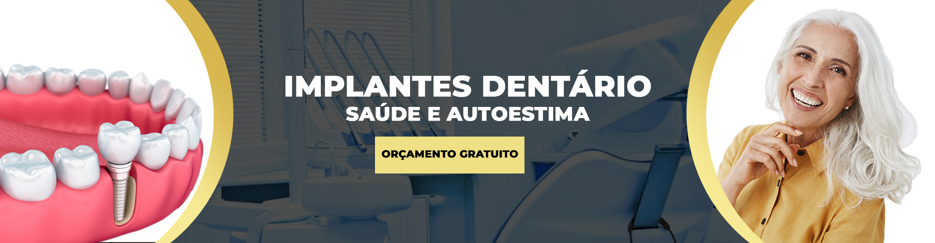 Implantes Dentários - Clínica Odontológica Dr. Mateo Bei