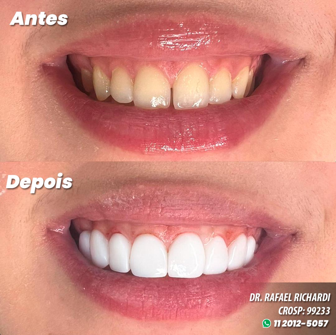 Facetas em Resina Antes e Depois - Dr. Mateo Bei