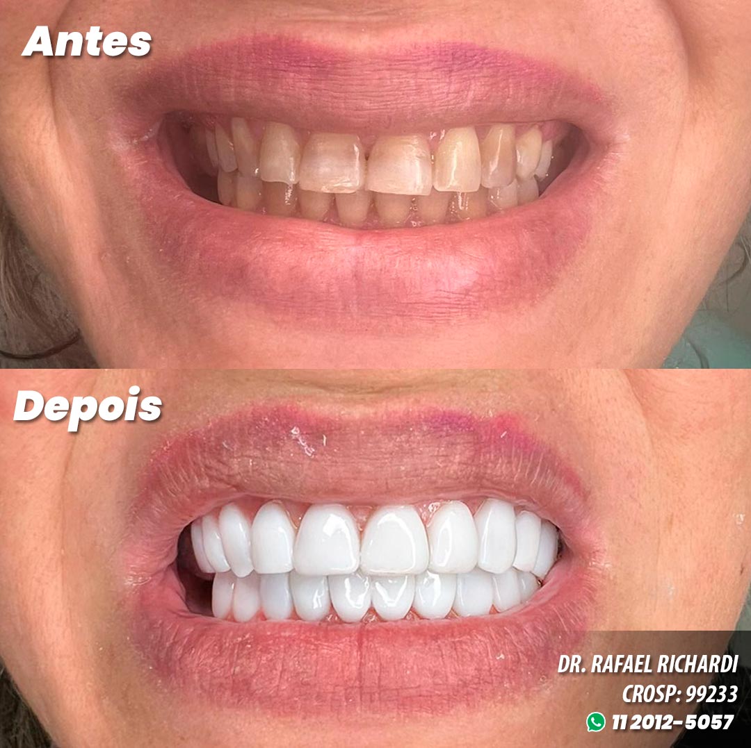 Facetas em Resina Antes e Depois - Dr. Mateo Bei