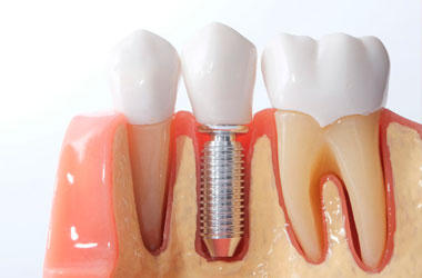 Implantes Dentários - Dr. Mateo Bei